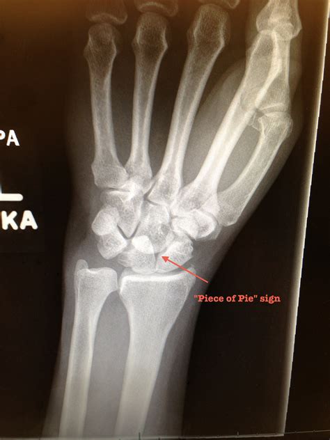 Image result for Lunate Dislocation Reduction