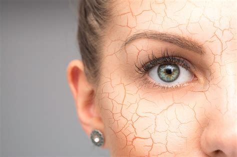 Bacne causes - Nutt So Ruff