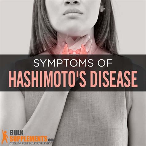 Hashimoto Disease Pdf | [PDF] Hashimoto’s thyroiditis following Graves‘ disease – SUOV