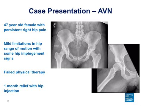 Bone Marrow Lesions of the Hip - Avascular Necrosis and Subchondral ...