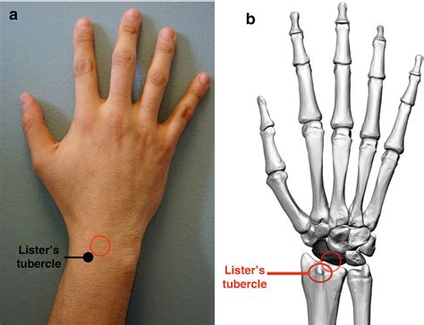 Image result for Distal Radius Fracture Recovery