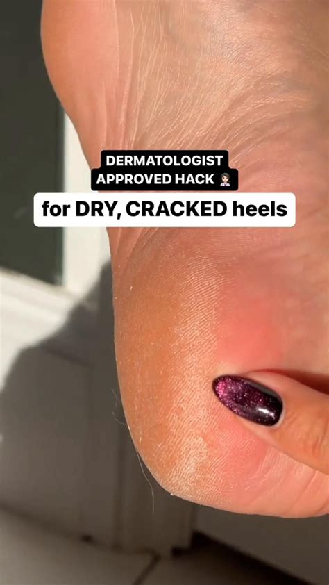 How to get rid of dead skin on feet step by step guide – Artofit