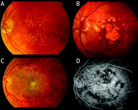 Age related macular degeneration | The BMJ