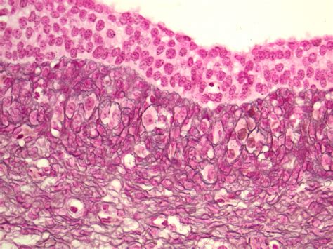Pathology Outlines - Follicle cyst