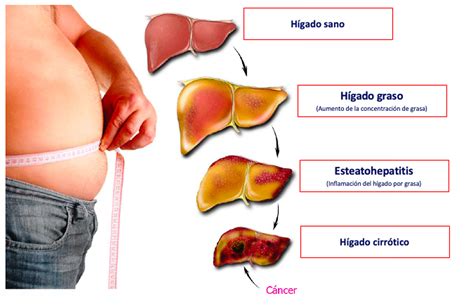 HÍGADO GRASO – HEPATICA