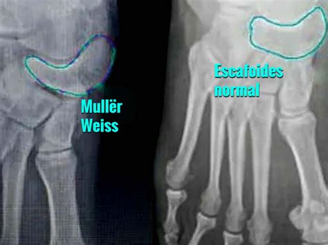Enfermedad de Müller-Weiss - Podología Aida García