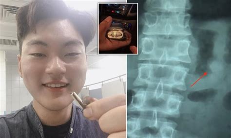 Apple AirPod Still Works After Being Swallowed Into Stomach - MobyGeek.com