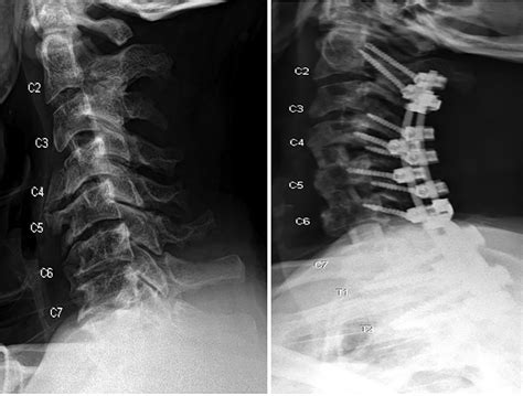 Anterior Longitudinal Ligament Calcification