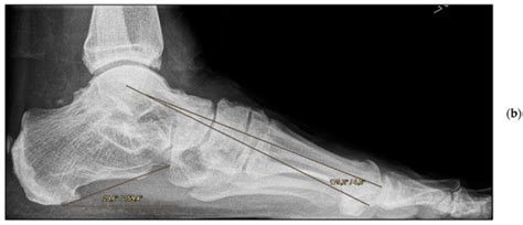 Adult-Acquired Flatfoot Deformity: Combined Talonavicular Arthrodesis ...