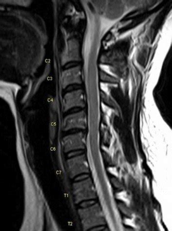 Magnetic resonance image. Radiology reported noted generalized disc ...