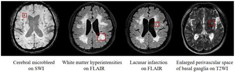 Glymphatic Dysfunction Mediates the Influence of White Matter Hyperintensities on Episodic ...