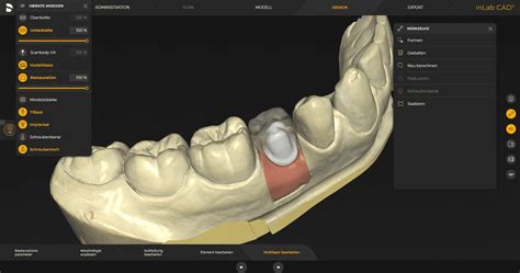 inLab Software: Dental CAD Software | Dentsply Sirona IN