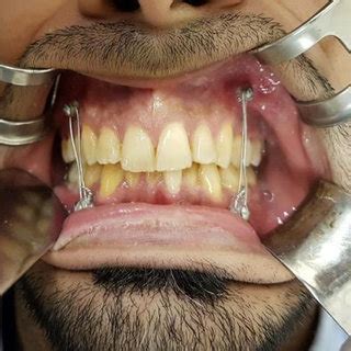 Inter Maxillary Fixation screws in situ by (0.5) mm stainless steel wires. | Download Scientific ...
