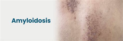 Amyloidosis: Symptoms, Types, Causes, and Treatments