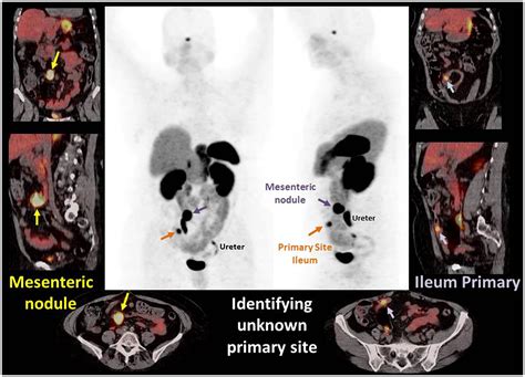 Post FDA approval analysis of 200 gallium-68 DOTATATE imaging: A retrospective analysis in ...