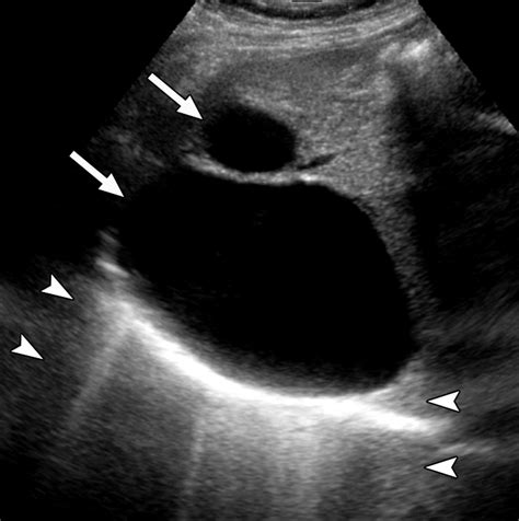 Fatty Cysts On Liver