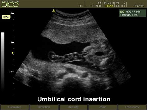 Bildergebnis für umbilical cord ultrasound images