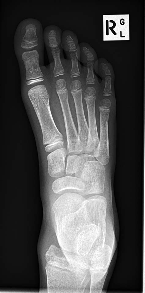 Greenstick metatarsal fracture | Image | Radiopaedia.org