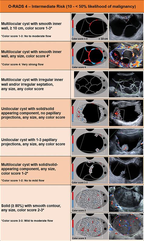 Classificação Acr Bi Rads 4 - RETOEDU
