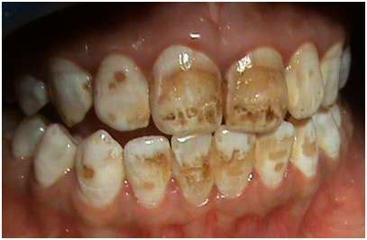 Image result for Tooth Stain