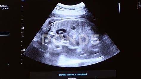 28 Weeks Ultrasound