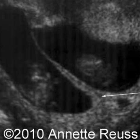 Twin Peaks Sign Ultrasound