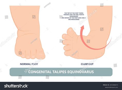 Talipes Equinovarus