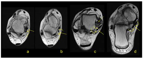 The Flexor Retinaculum Connects the Surrounding Structures into the Medial Ankle Complex