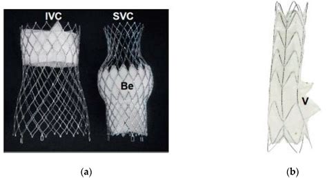Transcatheter Tricuspid Regurgitation Repair—An Overview of Techniques ...