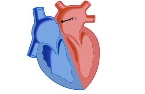 Man discovers he has a hole in his heart after stroke