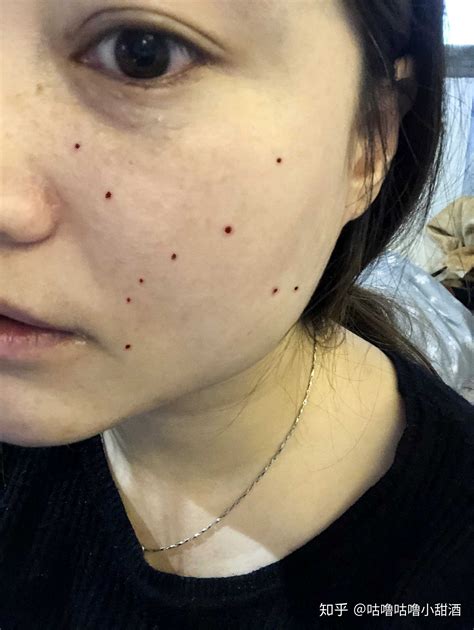 激光点痣留坑了怎么办? - 知乎