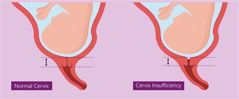 Short Cervix In Spanish at Nancy Hickman blog