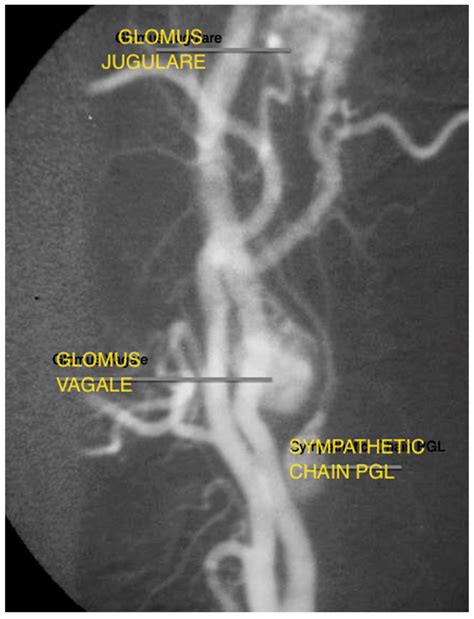 Glomus Tumor X Ray