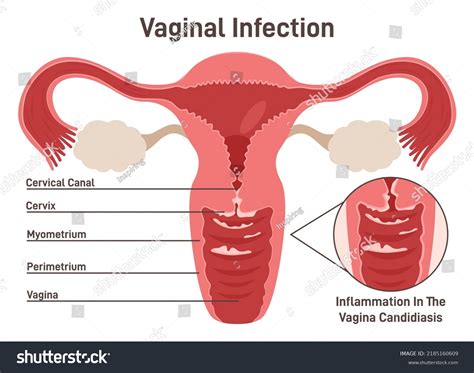 Vaginal Candidiasis