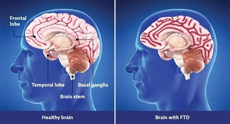 Frontotemporal dementia - A comprehensive guide