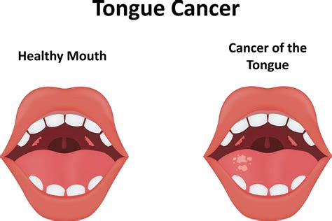 What Do Bumps On The Back Of The Tongue Mean?