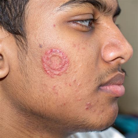 Best Doctor for Fungal Infection in Lucknow | Top Treatment Options
