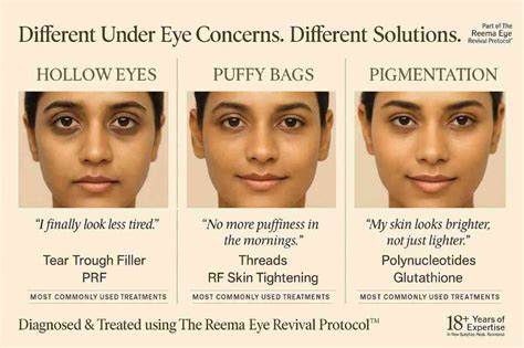 Dark Circles Treatment in Delhi (2026) – Laser, Under Eye Fillers, Cost ...