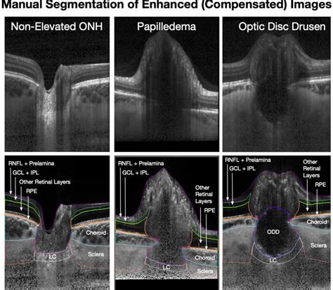 Figure 2 from 3D Structural Analysis of the Optic Nerve Head to Robustly Discriminate Between ...