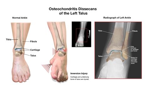 ankle injury Archives - Jackie Heda | Biomedical & Scientific Visuals