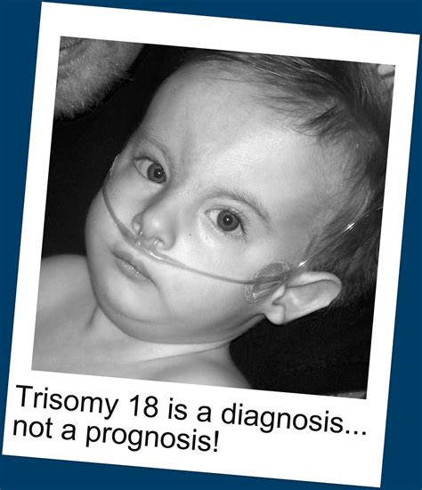 Edwards syndrome Wikipedia the free encyclopedia | Pics - HD Wallpaper ...