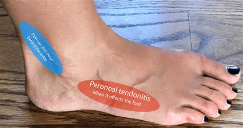Peroneal Tendonitis - Almawi Limited The Holistic Clinic