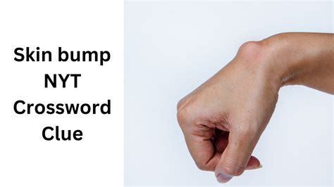 Skin bump NYT Crossword Clue - August 28 2024