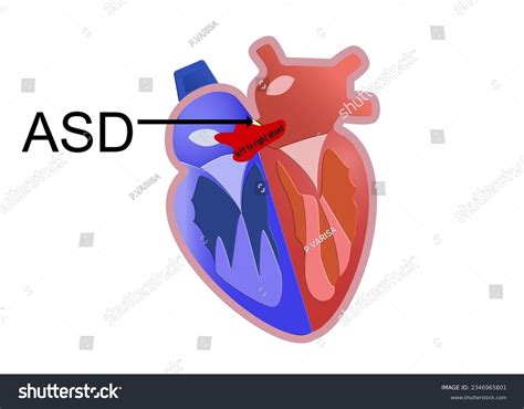 1 Right Left Cardiac Shunt Stock Vectors and Vector Art | Shutterstock