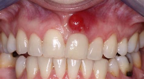 Surgical Gum Treatments | Wisdom Tooth Extraction Bangalore