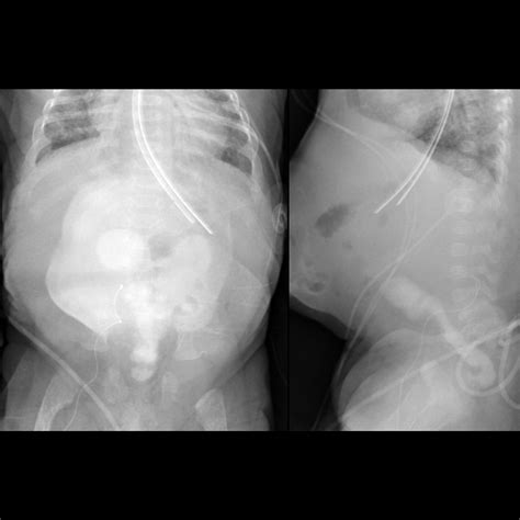 Infant with an omphalocele after lower extremity PICC line placement | Pediatric Radiology Case ...