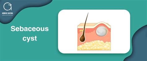 Sebaceous cyst | Dr/ Ahmed Safina