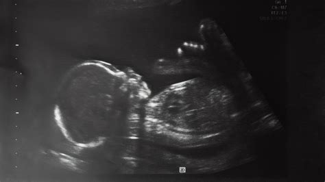 20-Week Ultrasound (Anatomy Scan): What You Should Know