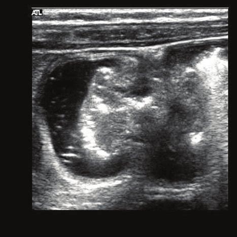 Hydrostatic Reduction of Intussusception 的图像结果