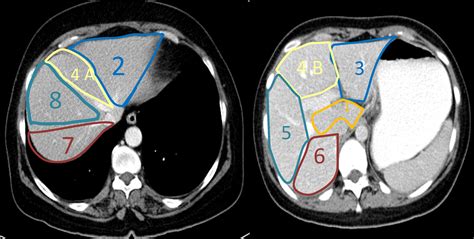 How To Measure Liver In Ct Scan at Annabelle Finlay blog